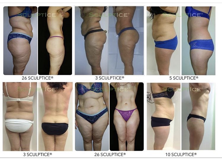 Body Sculp, Body Contouring Treatment