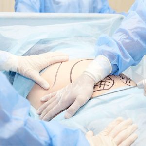 lymphatic drainage liposuction