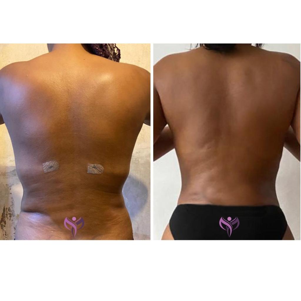 Body Contouring  Lymphatic Drainage, Post-op Manual Lymphatic