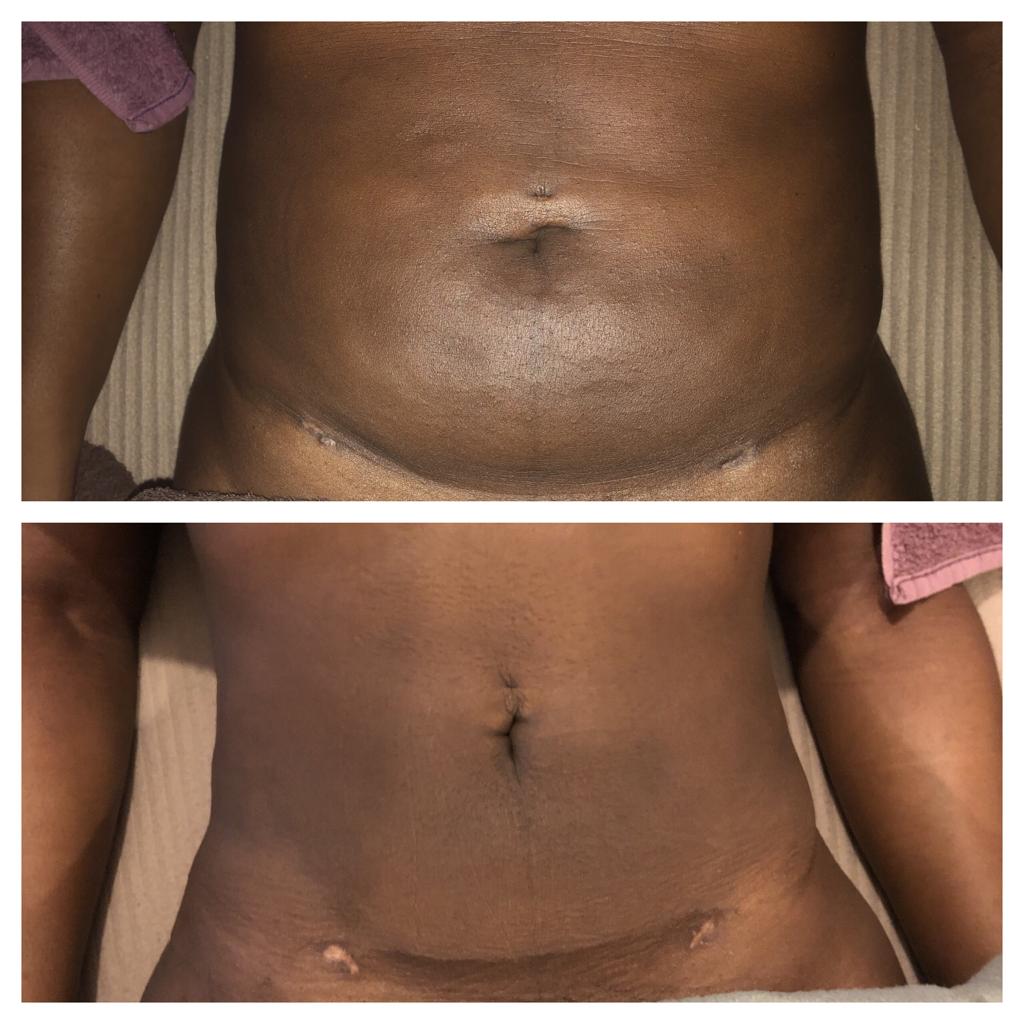 Body Contouring  Lymphatic Drainage, Post-op Manual Lymphatic