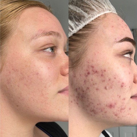 acne treated with light therapy