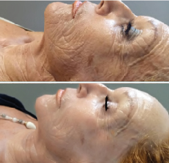 facelift and wrinkle treatment