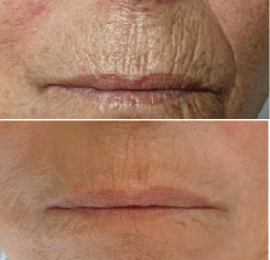 before and after anti wrinkle treatment