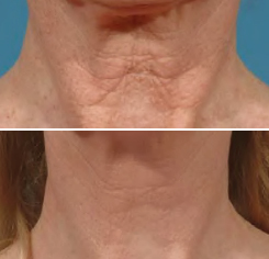 neck anti wrinkle treatment