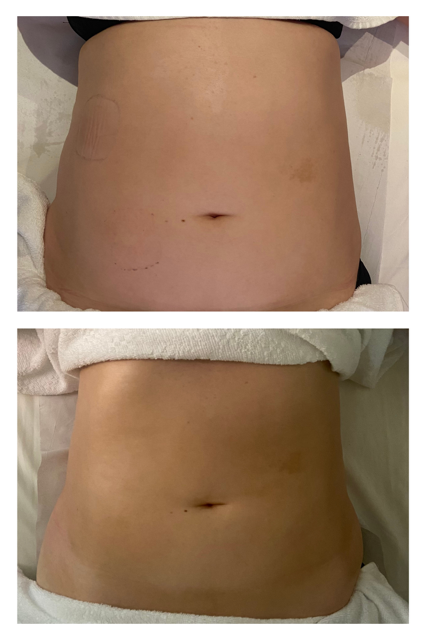 brazilian contouring