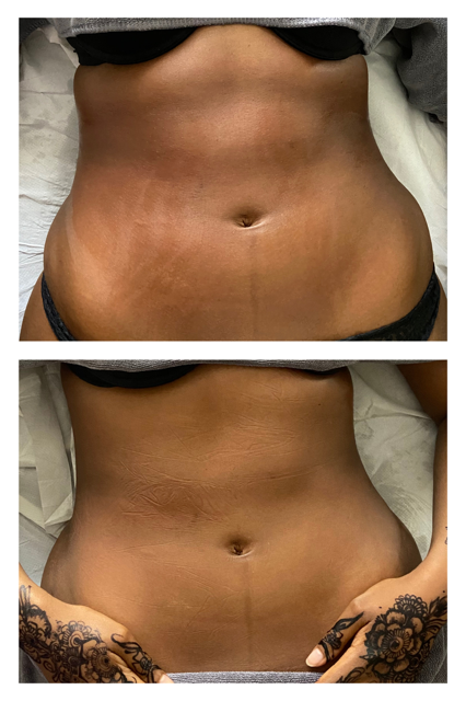 Brazilian contouring