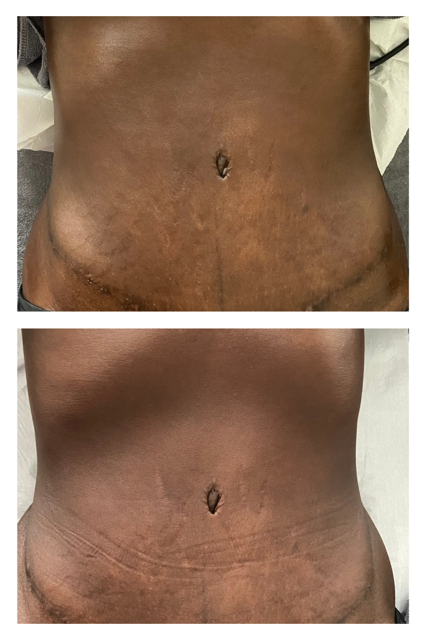 brazilian contouring
