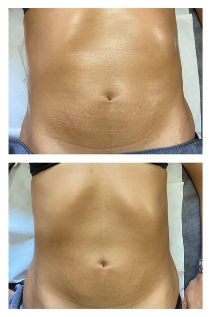 brazilian contouring